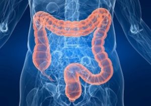 PROFILAKTYKA SCHORZEŃ RAKA JELITA GRUBEGO I PROSTATY